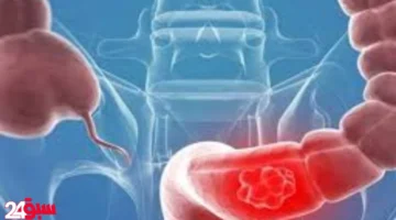 سرطان القولون.. دراسة تكشف عن وجبة مقرمشة تقلل خطر الإصابة به للنصف